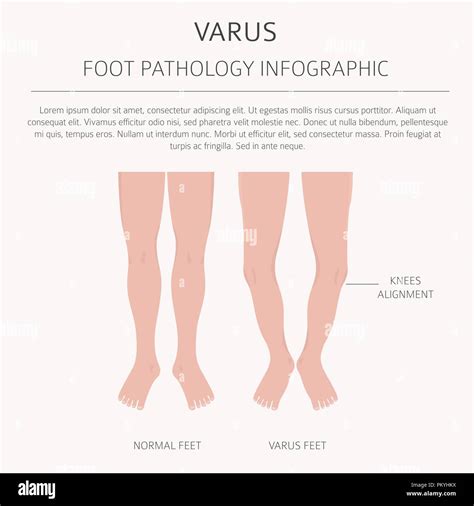 Foot Deformation As Medical Desease Infographic Valgus And Varus Defect Vector Illustration