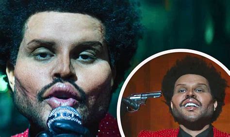 Bandages Are Off The Weeknds Plastic Surgery Look Shocks Fans