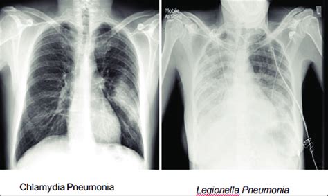 X Ray Image Of Chest And Cause Of Pneumonia By Chlamydia Pneumonia And