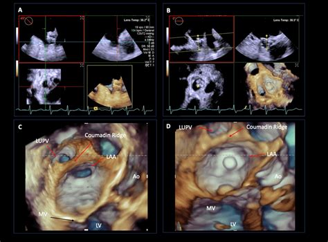 Three Dimensional Acquisition Of The Left Atrial Appendage Laa At