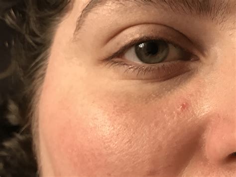 Skin Concern Redness And Red Bump On Face Rskincareaddiction