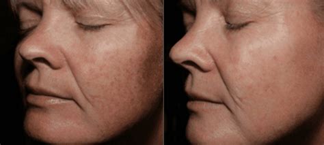 Ipl Photo Facial Skin Rejuvenation And Spot Reduction Philadelphia