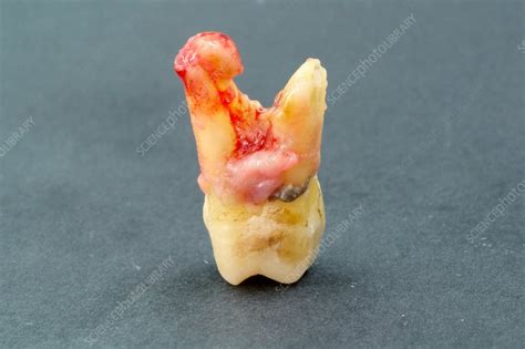 Extracted Wisdom Tooth Stock Image C0299593 Science Photo Library