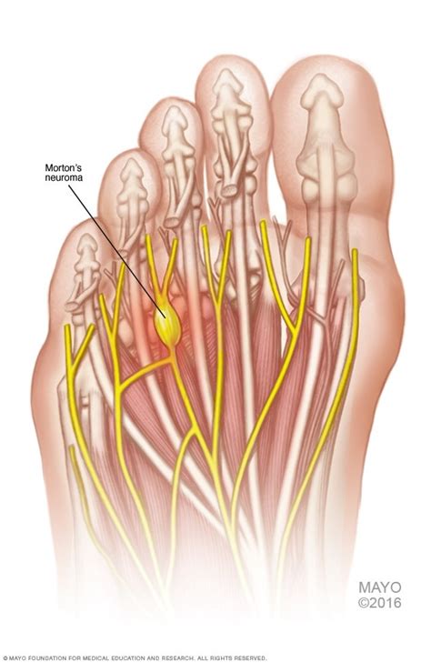So What Is Mortons Neuroma Fit2function Clinics