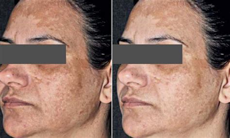 Melasma Hyperpigmentation And Brown Spots What S The Difference