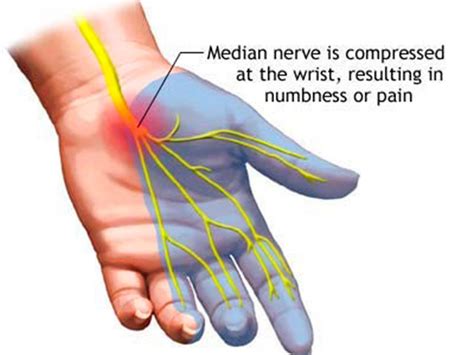 Carpal Tunnel Syndrome Often Seen Too Often Missed Clinica Sandalf