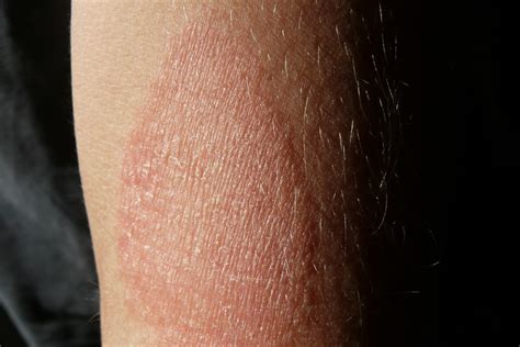 Dermatitis At Pica Por Qu Aparece Y C Mo Debes Cuidarte Si La Padeces