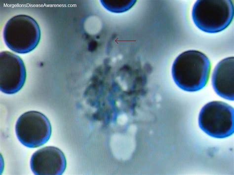 Morgellons Disease Awareness Live Blood Microscopy In A Person