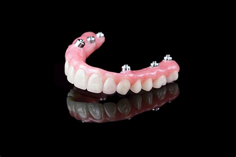 Hybrid Denture — Microdental Laboratories