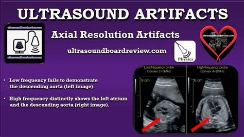 Axial Resolution Artifacts Ultrasound Physics Ultrasound Sonography