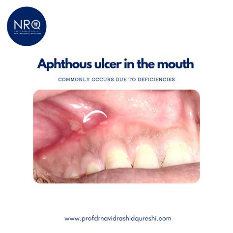 Aphthous Ulcer In The Mouth Drprofnavidqureshi Medium