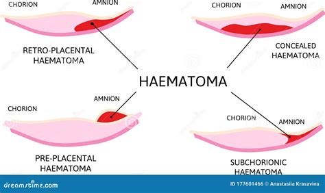 Hematoma Placentario Coágulos De Sangre Que Surgen De La Placenta
