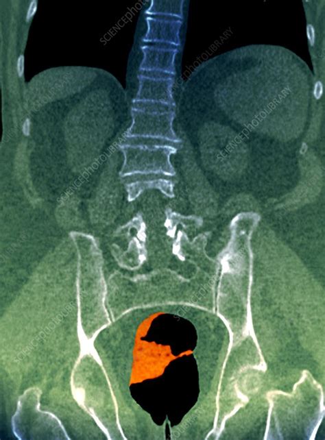 Cancer Of The Rectum Ct Scan Stock Image C0071645 Science Photo