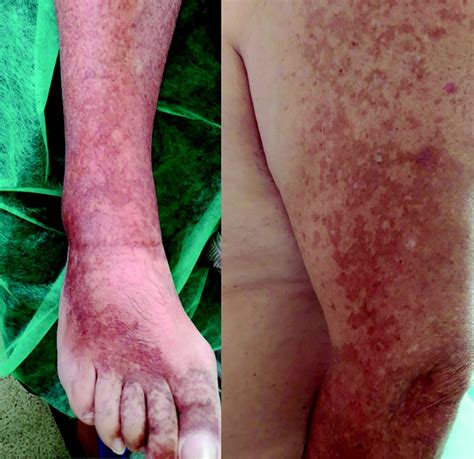 Drug Induced Hyperpigmentation Review And Case Series American Board