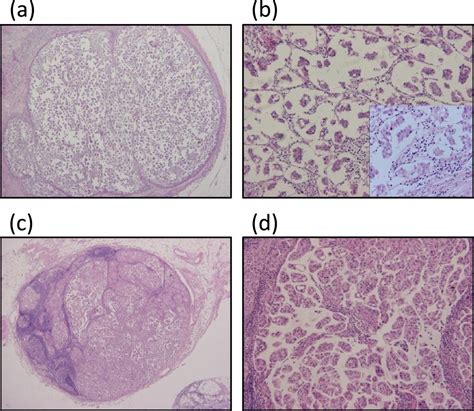 A Case Of Invasive Micropapillary Carcinoma Of The Breast Involving
