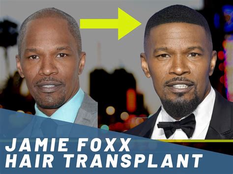 Jamie Foxx Hair Transplant Hair Loss Technical Analysis
