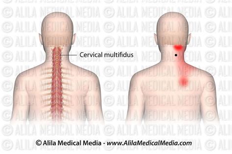 Alila Medical Media Trigger Points And Referred Pain Patterns For The