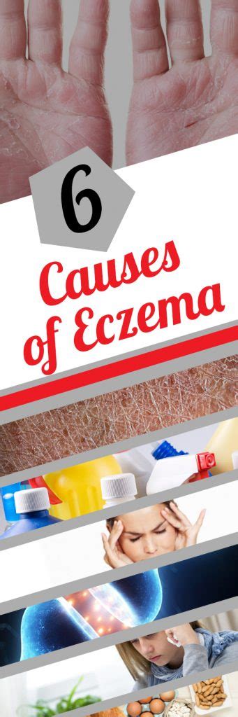 6 Causes Of Eczema