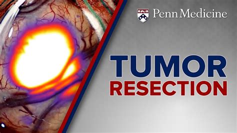 Head And Neck Tumor Resection At Penn Medicine Youtube