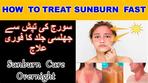 How To Treat Sunburn Short Tips For Burnt Skin Youtube