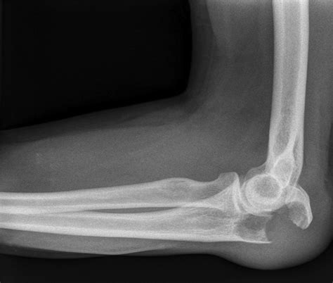 Total Elbow Replacement For Giant Cell Tumor Of Bone After Denosumab Treatment A Case Report