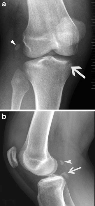 A Oblique Radiograph Of The Right Knee Showing A Subtle Fracture Of The