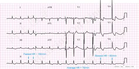 As far as the palpitations the best way to dianosis exactly what is going on is with a holter monitor test. ECG on emaze