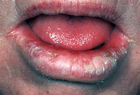 Conduct a self exam at least once a month. What does Mouth Lip Cancer Looks Like? - HTQ