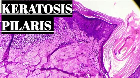 Keratosis Pilaris Histopathology Youtube