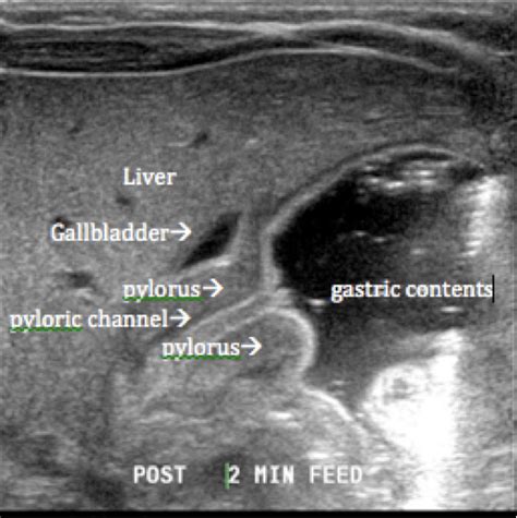 Target Sign In Pyloric Stenosis This Gastric Distention In A Vomiting