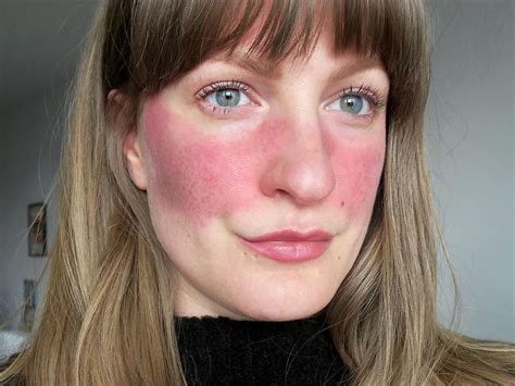 Neutrogena Light Therapy For Rosacea Light Therapy Treatments