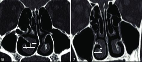 Non Contrast Coronal Sinonasal Computed Tomography CT Scan Images