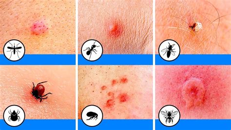 10 Bug Bites You Should Be Able To Identify Bug Bite Images Red Bug