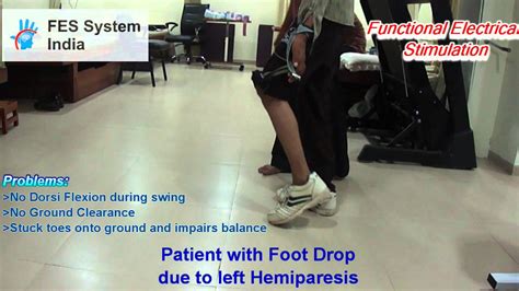 Fes Functional Electrical Stimulation For Foot Drop Due To Hemiplegia