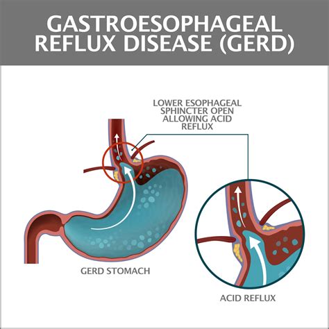 A Lump In Your Throat Symptom Gastroenterology Of Greater Orlando