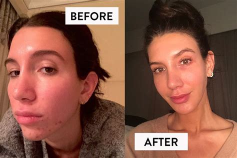 This Little Known Supplement Stopped My Hormonal Acne Breakouts For Good