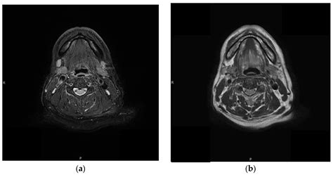 Diagnostics Free Full Text Bilateral Cervical Lymphadenopathy After