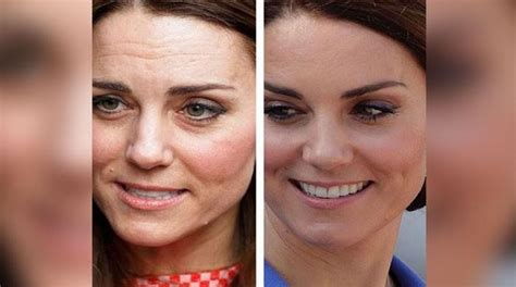 Kate Middleton Before And After Botox
