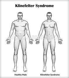 Klinefelter Syndrome Klinefelter Syndrome Syndrome Genetic Disorders