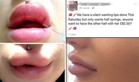 Save Face In The Express Revealed Lip Filler Frenzy Leaving Teenage