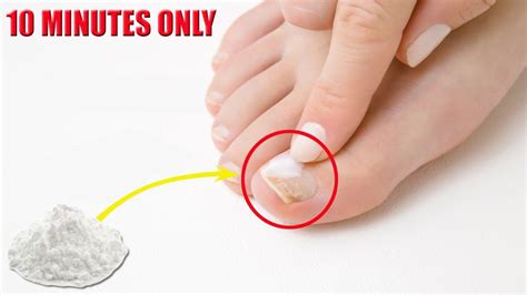Emuaid kills toe nail fungus on contact and eliminates 99.99% of bacteria in under 1 min. Toenail Fungus | How to Treat Toenail Fungus Fast at Home ...