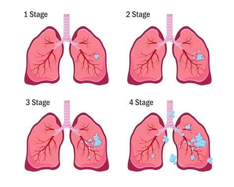 Symptomes Cancer Du Poumon Stade 1 Communaut Mcms - Rezfoods - Resep