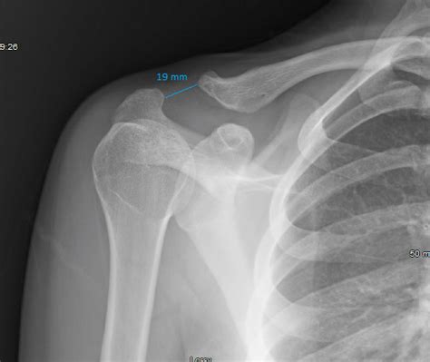 Severe And Rapid Post Traumatic Osteolysis Of The Distal Clavicle In A