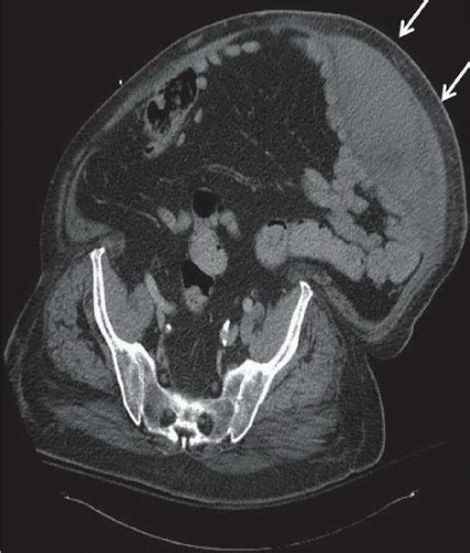 Rectus Sheath Hematoma Radiology Key