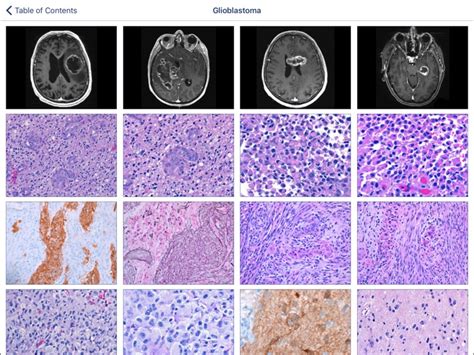 Johns Hopkins Atlas Of Surgical Neuropathology By Johns Hopkins Mobile