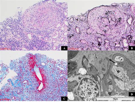 A Case Of Dual Positive Glomerulonephritis With Plasma Cell Dyscrasia