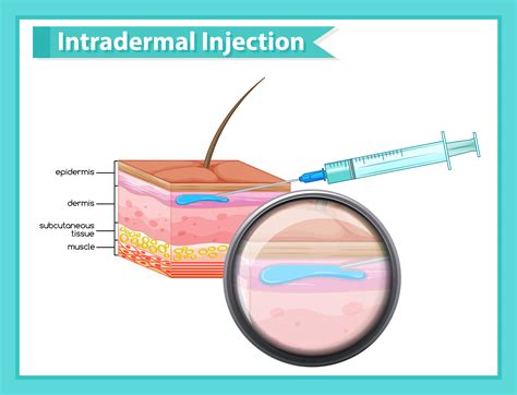 Scientific Medical Illustration Of Intradermal Injection 1361054 Vector