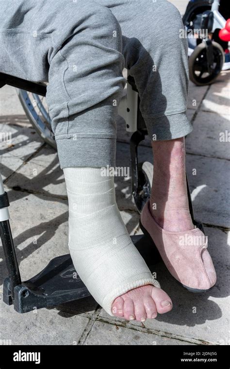 Cast Ankle On An Elderly Person Fracture Of The Malleolus Stock Photo