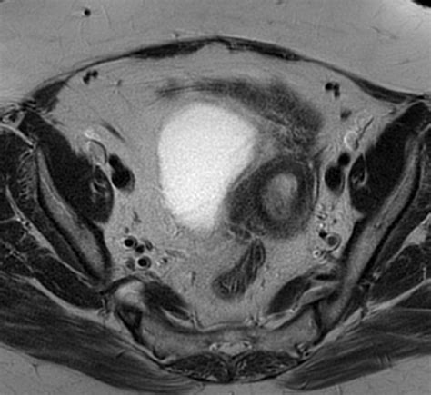 Endometrial Polyp Image