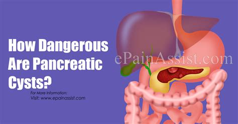 Types Of Pancreatic Cysts